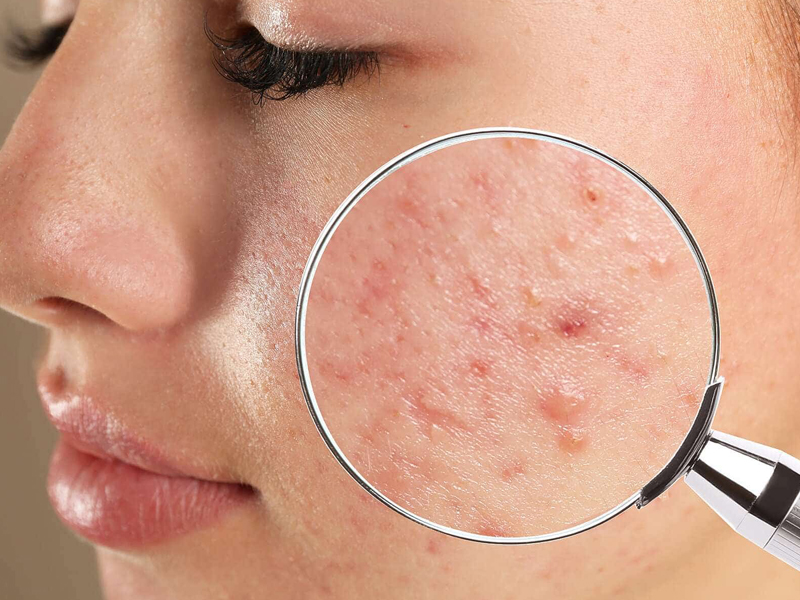 adult acne products
